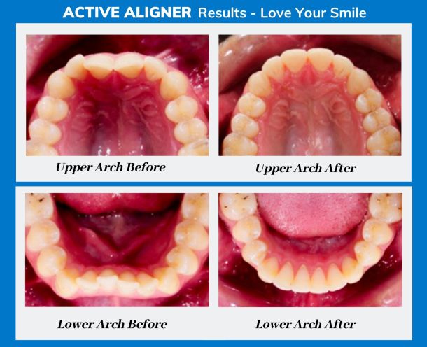 Dr Marc Sher Active Aligners