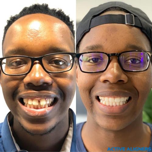 ACTIVE ALIGNERS - Before and After