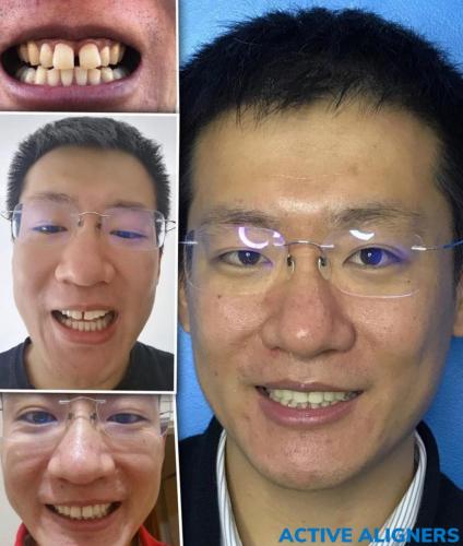 ACTIVE ALIGNERS - Before and After