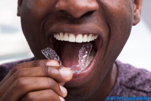 ACTIVE ALIGNERS Clear Braces - guy about to wear them