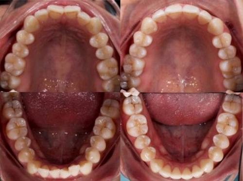 Active-Aligners-before-and-after-reviews