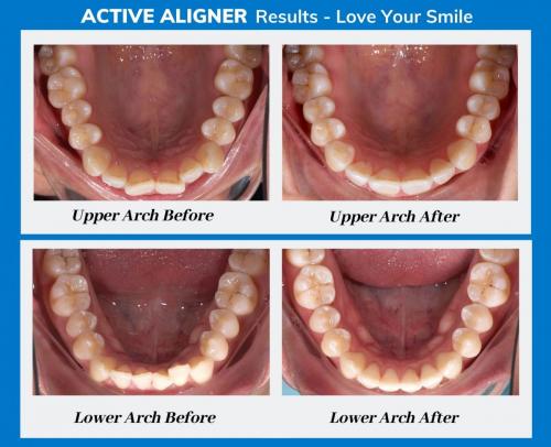 Active Aligners review before and after