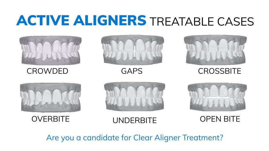 Illustration of types of occlusions treatable with Active Aligners